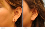 Torn earlobe repair