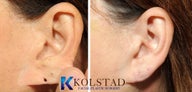 Earlobe Repair
