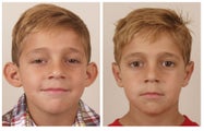 Otoplasty