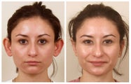 Otoplasty