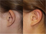 Otoplasty