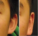 Ear Surgery - Otoplasty