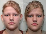 Otoplasty (Ear surgery)