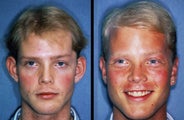 Ear Reshaping (Otoplasty)
