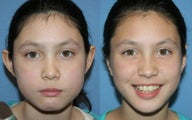 Otoplasty
