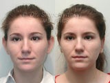 Otoplasty (Ear surgery)