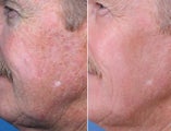 Evolence Chin and Smile Lines