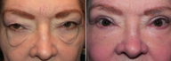 Eyelid Surgery - Festoons