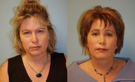 Facelift, Full Face Co2 Laser Resurfacing, Fat Transfer, Upper and Lower Blepharoplasty, Browlift