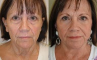 Lower Eyelids (blepharoplasty), Image Lift