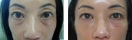 Lower Eyelid Rejuvenation