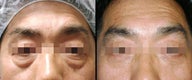 Lower Eyelid(Blepharoplasty) Surgery
