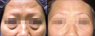 Lower Eyelid(Blepharoplasty) Surgery
