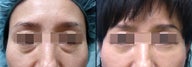 Lower Eyelid(Blepharoplasty) Surgery