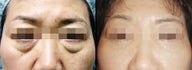 Lower Eyelid(Blepharoplasty) Surgery