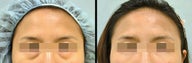 Lower Eyelid(Blepharoplasty) Surgery