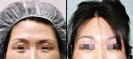 Lower Eyelid(Blepharoplasty) Surgery