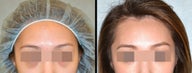 Lower Eyelid(Blepharoplasty) Surgery
