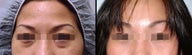 Lower Eyelid(Blepharoplasty) Surgery