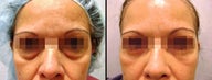 Lower Eyelid(Blepharoplasty) Surgery