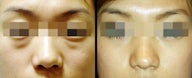 Lower Eyelid(Blepharoplasty) Surgery