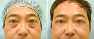 Lower Eyelid(Blepharoplasty) Surgery