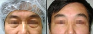 Lower Eyelid(Blepharoplasty) Surgery