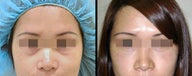 Lower Eyelid(Blepharoplasty) Surgery