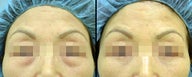 Lower Eyelid(Blepharoplasty) Surgery