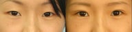 Asian Blepharoplasty ("Double Eyelid" Procedure)
