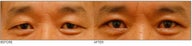 Asian Blepharoplasty ("Double Eyelid" Procedure)