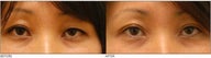 Asian Blepharoplasty ("Double Eyelid" Procedure)