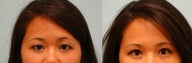 Asian Blepharoplasty ("Double Eyelid" Procedure)