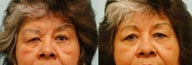 Facial Reconstruction