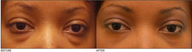 Lower Eyelid Blepharoplasty