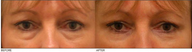 Lower Eyelid Blepharoplasty