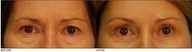 Lower & Upper Eyelid Blepharoplasty, Browlift