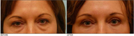 Lower & Upper Eyelid Blepharoplasty, Browlift, Fat Transfer