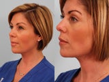 Lower blepharoplasty