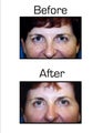 Blepharoplasty