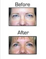 Blepharoplasty