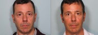 Blepharoplasty