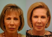 Full Face Fat Transfer and upper blepharoplasty