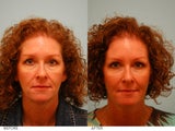 Fat Transfer and Upper Blepharoplasty