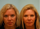 Full Face Fat Transfer
