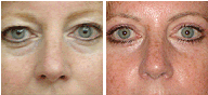 Blepharolplasty