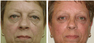 Blepharoplasty