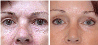 Blepharoplasty