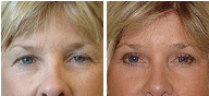 Eyelid Surgery