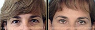 Upper and Lower Eye (Blepharoplasty)
